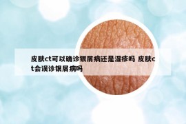 皮膚ct可以確診銀屑病還是濕疹嗎 皮膚ct會(huì)誤診銀屑病嗎