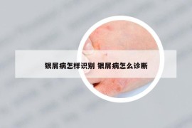 銀屑病怎樣識別 銀屑病怎么診斷