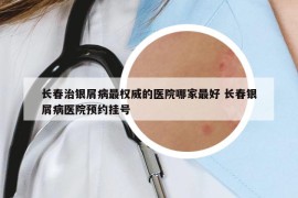 長(zhǎng)春治銀屑病最權(quán)威的醫(yī)院哪家最好 長(zhǎng)春銀屑病醫(yī)院預(yù)約掛號(hào)