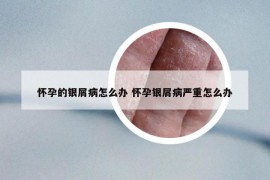 懷孕的銀屑病怎么辦 懷孕銀屑病嚴(yán)重怎么辦