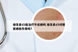 維生素d3能治療牛皮癬嗎 維生素d3對銀屑病有作用嗎?