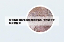 徐州有能治好銀屑病的醫(yī)院嘛嗎 徐州最好的銀屑病醫(yī)生