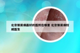 北京銀屑病最好的醫(yī)院在哪里 北京銀屑病權(quán)威醫(yī)生