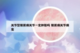 關(guān)節(jié)型銀屑病關(guān)節(jié)一定腫脹嗎 銀屑病關(guān)節(jié)病變
