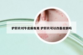 護肝片對牛皮癬有用 護肝片可以改善皮膚嗎