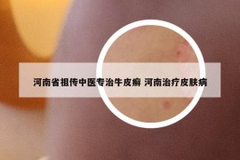 河南省祖?zhèn)髦嗅t(yī)專治牛皮癬 河南治療皮膚病