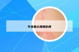 牛皮癬火辣辣的疼