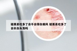 褪黑素吃多了會(huì)不會(huì)得白癜風(fēng) 褪黑素吃多了會(huì)長白頭發(fā)嗎
