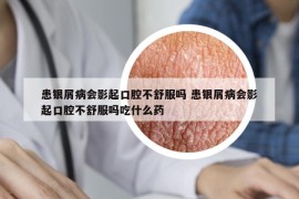 患銀屑病會影起口腔不舒服嗎 患銀屑病會影起口腔不舒服嗎吃什么藥
