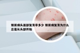 銀屑病頭面部復(fù)發(fā)率多少 銀屑病復(fù)發(fā)為什么總是從頭部開始