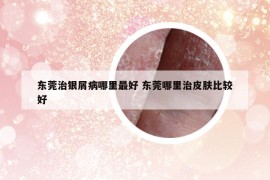 東莞治銀屑病哪里最好 東莞哪里治皮膚比較好