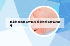 臉上長(zhǎng)癬怎么買什么藥 臉上長(zhǎng)癬買什么藥膏好
