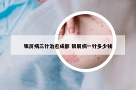 銀屑病三針治愈成都 銀屑病一針多少錢(qián)