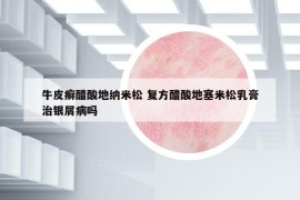 牛皮癬醋酸地納米松 復方醋酸地塞米松乳膏治銀屑病嗎