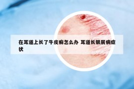 在耳道上長了牛皮癬怎么辦 耳道長銀屑病癥狀