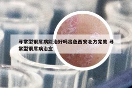 尋常型銀屑病能治好嗎出色西安北方完美 尋常型銀屑病治愈