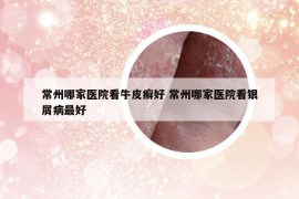 常州哪家醫(yī)院看牛皮癬好 常州哪家醫(yī)院看銀屑病最好