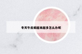 冬天牛皮癬越來(lái)越多怎么辦呢