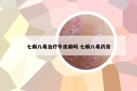 七癬八毒治療牛皮癬嗎 七癬八毒藥膏