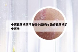 中醫(yī)銀屑病醫(yī)院有哪個最好的 治療銀屑病的中醫(yī)院