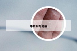 牛皮癬與免疫
