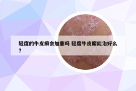 輕度的牛皮癬會加重嗎 輕度牛皮廨能治好么?