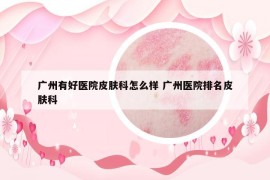 廣州有好醫(yī)院皮膚科怎么樣 廣州醫(yī)院排名皮膚科