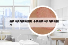 癬的種類與辨別圖片 小孩癬的種類與辨別圖片