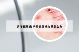 月子銀屑病 產(chǎn)后銀屑病加重怎么辦