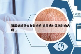 銀屑病對牙齒有影響嗎 銀屑病對生活影響大嗎