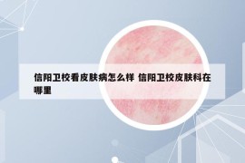 信陽衛(wèi)?？雌つw病怎么樣 信陽衛(wèi)校皮膚科在哪里