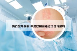 傷口型牛皮癬 牛皮膚癬會通過傷口傳染嗎