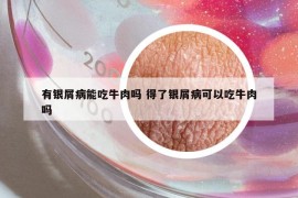 有銀屑病能吃牛肉嗎 得了銀屑病可以吃牛肉嗎