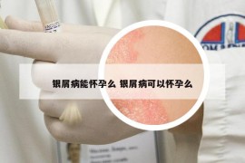 銀屑病能懷孕么 銀屑病可以懷孕么