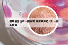 銀屑病旁邊有一圈白斑 銀屑病旁邊長出一些小疙瘩