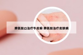 脾氨肽口治療牛皮癬 脾氨肽治療皮膚病