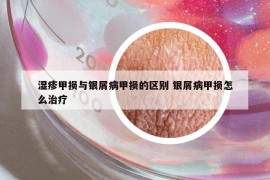 濕疹甲損與銀屑病甲損的區(qū)別 銀屑病甲損怎么治療