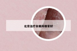 北京治療白癜風哪家好