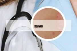 薔薇癬