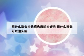 用什么洗頭治頭癬頭癬能治好嗎 用什么洗頭可以治頭癬