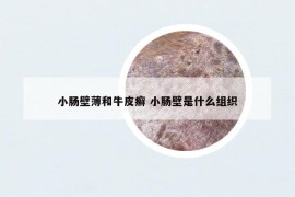 小腸壁薄和牛皮癬 小腸壁是什么組織