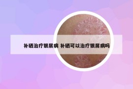 補(bǔ)硒治療銀屑病 補(bǔ)硒可以治療銀屑病嗎