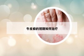 牛皮癬的初期如何治療