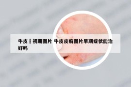 牛皮癬初期圖片 牛皮皮癬圖片早期癥狀能治好嗎