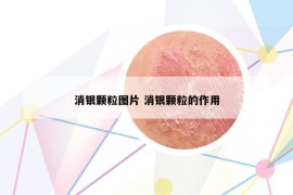 消銀顆粒圖片 消銀顆粒的作用