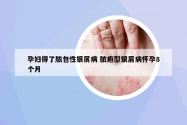 孕婦得了膿包性銀屑病 膿皰型銀屑病懷孕8個(gè)月