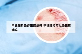 甲鈷胺片治療銀屑病嗎 甲鈷胺片可以治銀屑病嗎