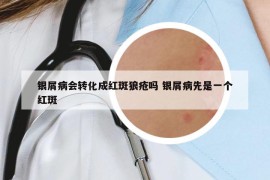 銀屑病會(huì)轉(zhuǎn)化成紅斑狼瘡嗎 銀屑病先是一個(gè)紅斑