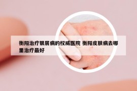 衡陽治療銀屑病的權(quán)威醫(yī)院 衡陽皮膚病去哪里治療最好