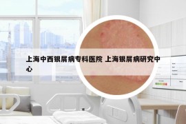 上海中西銀屑病專(zhuān)科醫(yī)院 上海銀屑病研究中心